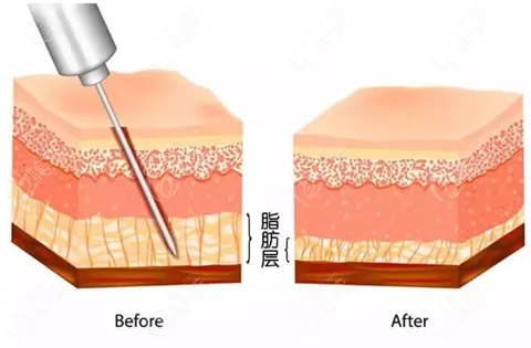 抽脂手術(shù)對身體有什么傷害？該不該禁止抽脂手術(shù)？